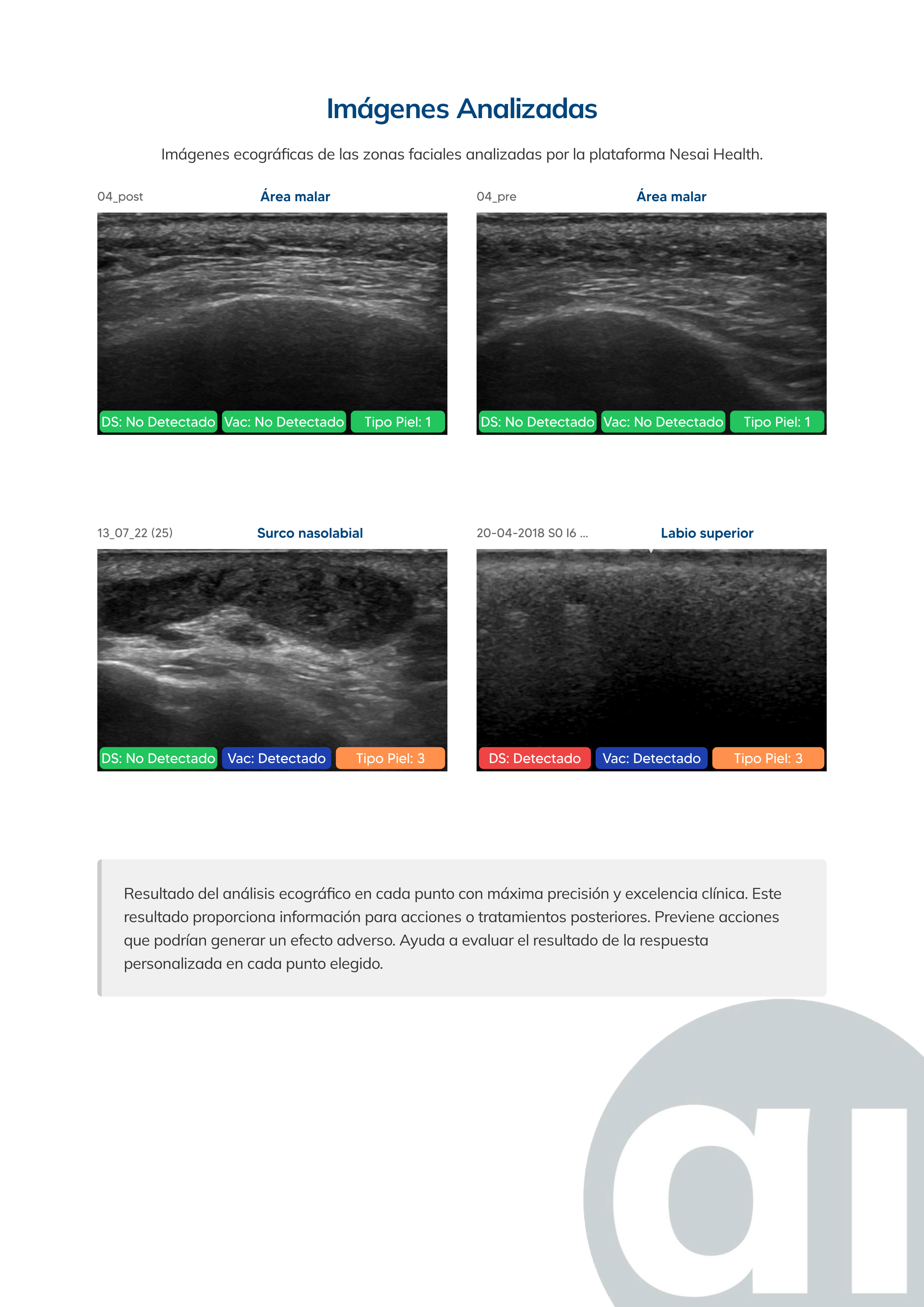 Ecogramas por zona facial de un informe real de Nesai Face, con detección de silicona y vacuolas