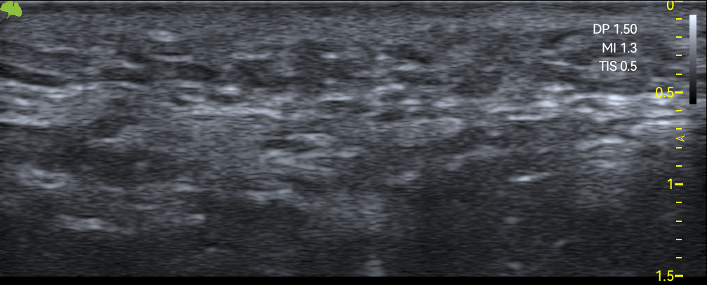 Real ultrasound of the malar area analysed by Nesai